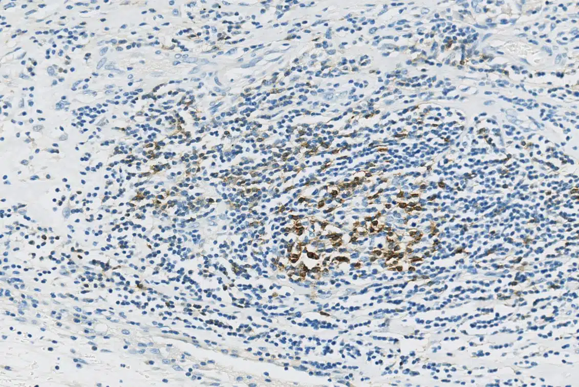 PD1-expression-in-Non-Small-Cell-Lung-Cancer